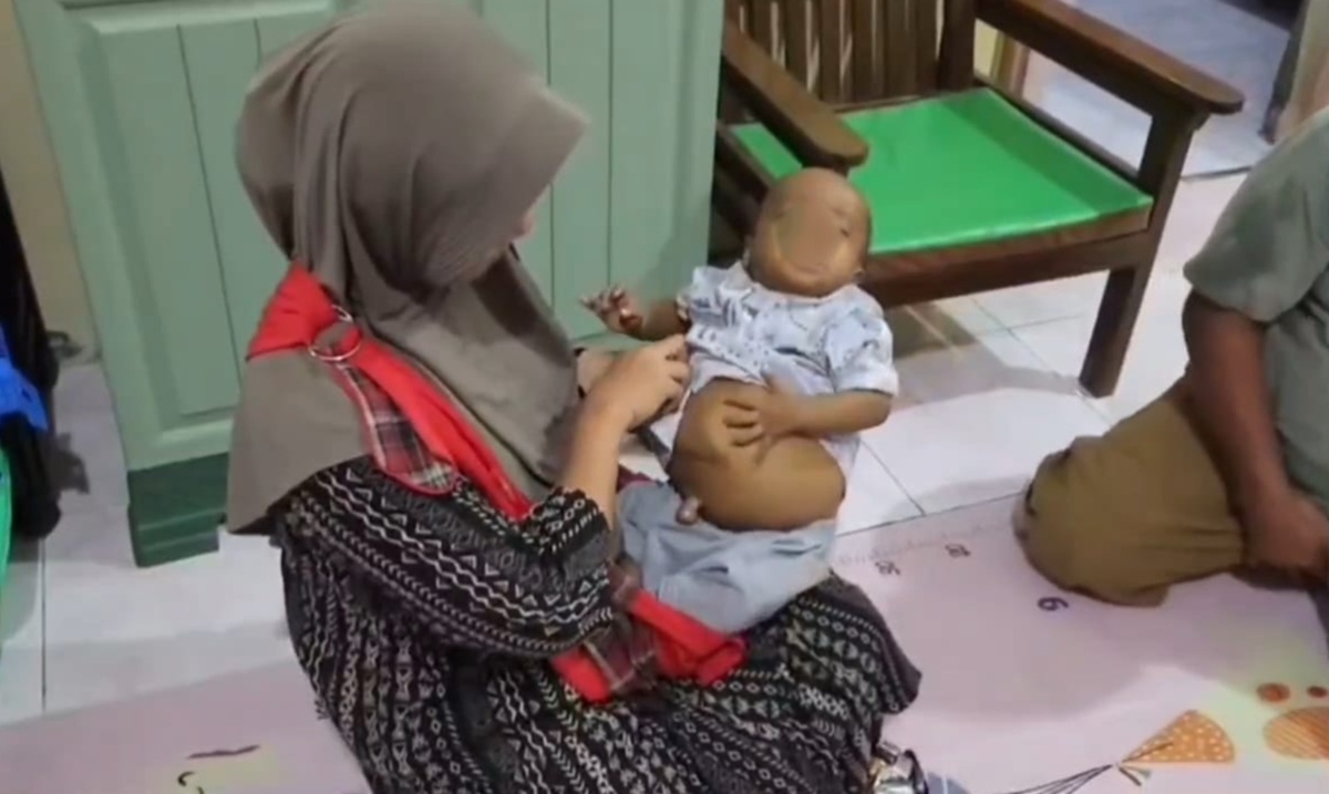 Mengenal Atresia Bilier, Penyakit Langka yang Mengancam Nyawa Bayi 8 Bulan di Cirebon