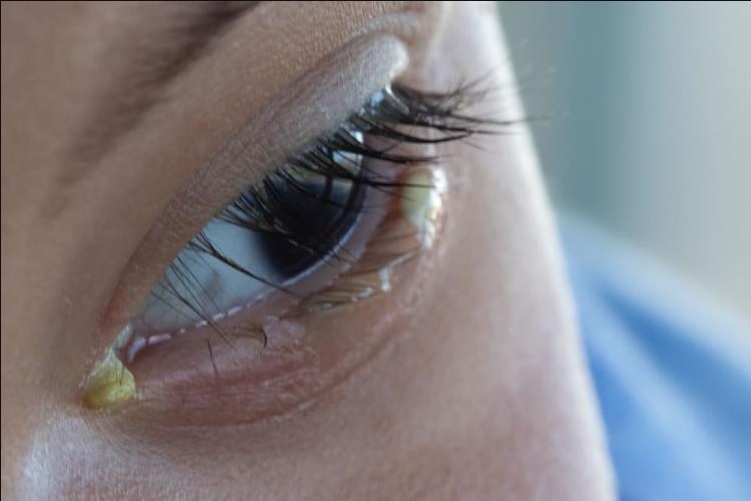 Mata Anak Anda Belekan, Ketahuilah Penyebab dan Bagaimana Cara Mengatasinya