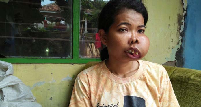 Suminar, Penderita Tumor Gusi yang Butuh Bantuan