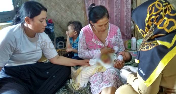 Bayi Pengidap Omfalokel di Majalengka Butuh Bantuan