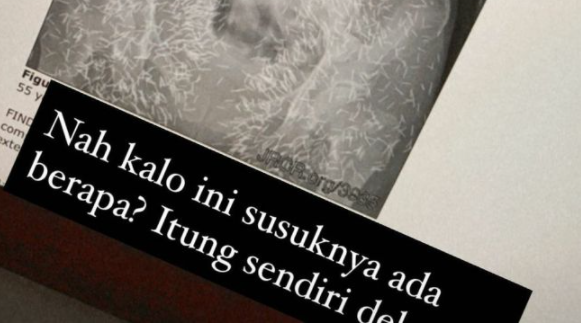 Buat yang Pasang Susuk, Begini Penampakannya di X-ray