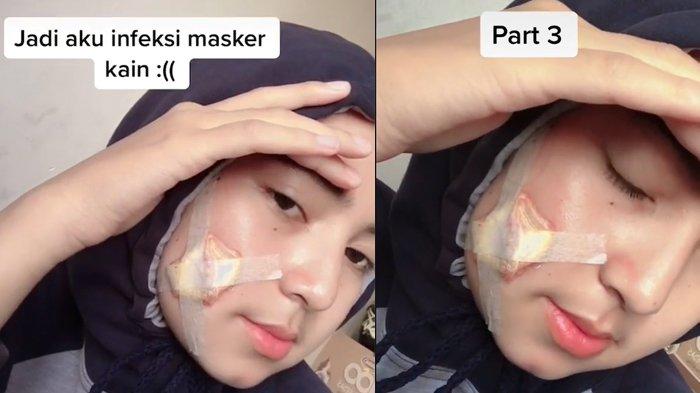 Viral, Wanita Ini Harus Operasi karena Infeksi dari Masker Kain