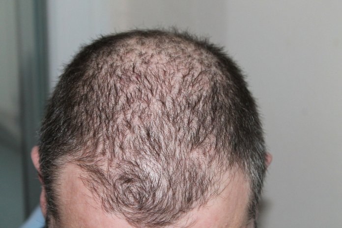 Ini Solusi Botak dan Rambut Rontok pada Pria, Kandungan Minyak Kemiri