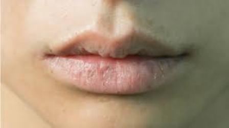 Nih Tips Merawat Bibir Kering Saat Puasa di Bulan Ramadhan
