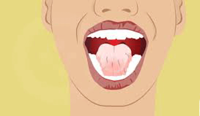 Awas! Mulut Kering Salah Satu Gejala Diabetes