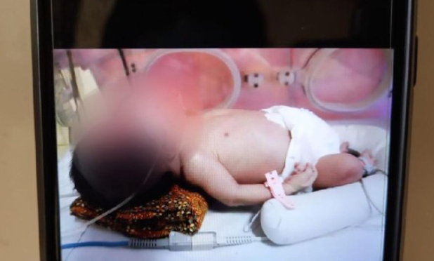 Bayi Berkepala Dua Lahir di Tegal, Hanya Punya Satu Tubuh