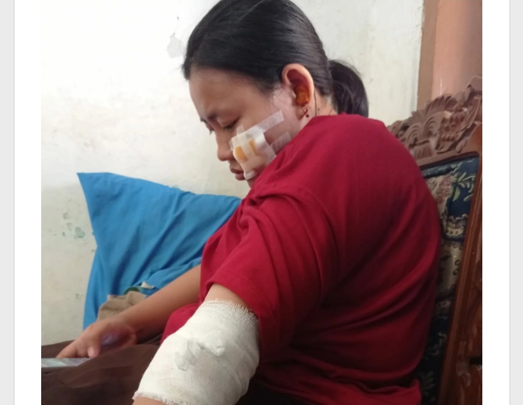 Siswi SMA dari Cirebon Girang Nekat Lawan Begal, Diserang Pakai Sajam di Jembatan Tol Grenjeng