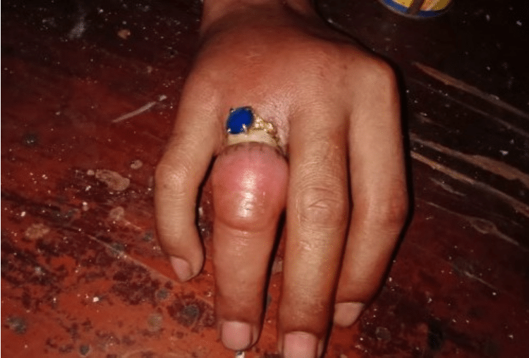 Cincin Tidak Bisa Dilepas Sampai Jari Bengkak, Pria Ini Minta Bantuan BPBD