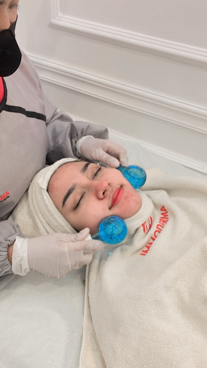 Acne Treatment, Perawatan Paling Diminati di Immoderma Cirebon