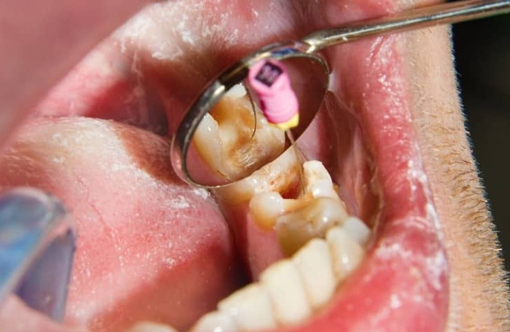 Cara Mengeluarkan Ulat Gigi dengan Kapas, Yuk! Simak Fakta Mengenai Ulat Gigi