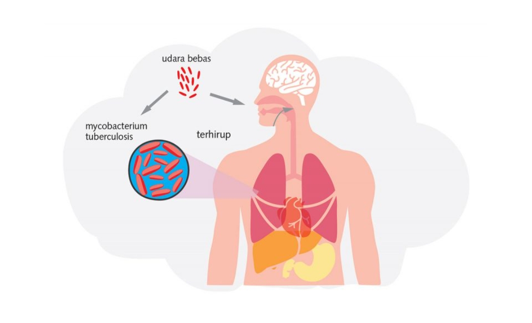 Inilah 7 Pendekatan untuk Tekan Angka Pasien Tuberkulosis yang Dilakukan Kemenkes RI