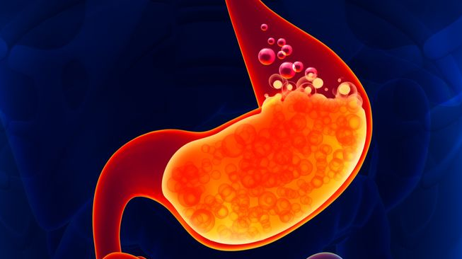 Wajib Tahu! Cara Menyembuhkan Asam Lambung Beserta Obatnya