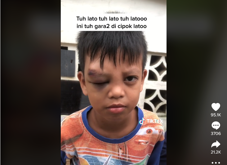 Ngeri! Video Anak Korban Lato-lato Bertambah, Mata Kanan Sampai Bengkak 