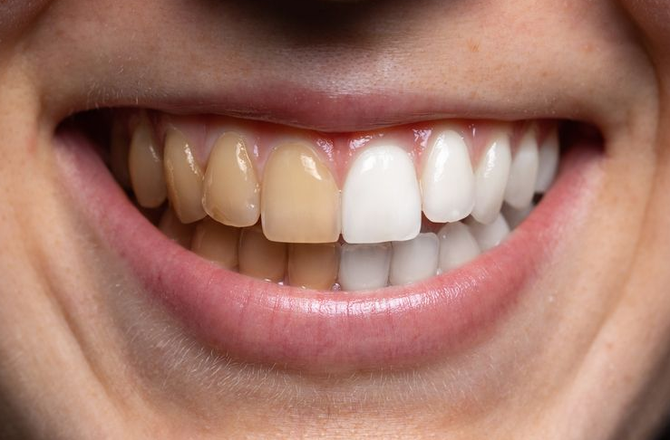 Malu Punya Gigi Kuning? 5 Cara Memutihkan Gigi Kuning yang Membandel Secara Alami