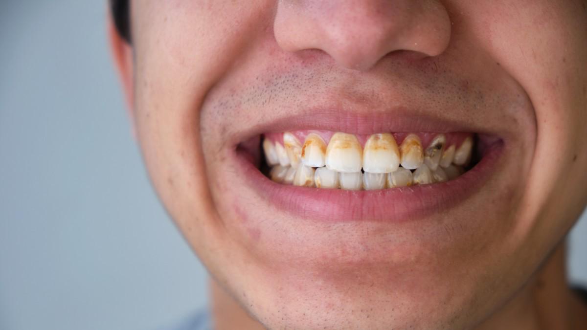 Wajib Tahu Ini Dia 6 Cara Menghilangkan Kerak Gigi yang Dengan Cara yang Sangat Efektif