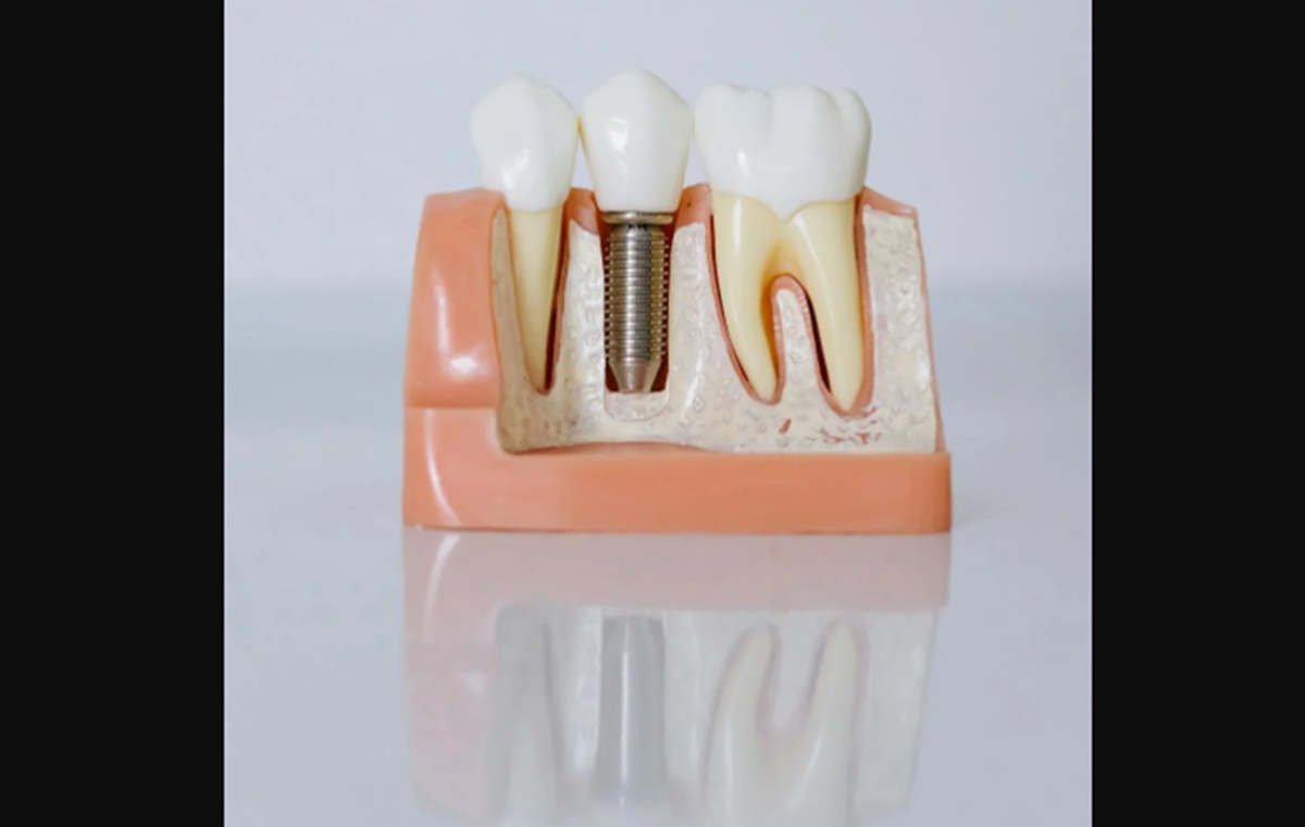 Lakukan 5 Kebiasaan Ini, Cara Efektif Menghilangkan Karang Gigi di Rumah