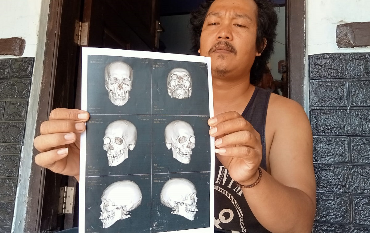 Tukang Bangunan Dihajar Massa di Tengah Tani Gara-gara Diteriaki Begal, Kini Cacat karena Patah Tulang Rahang