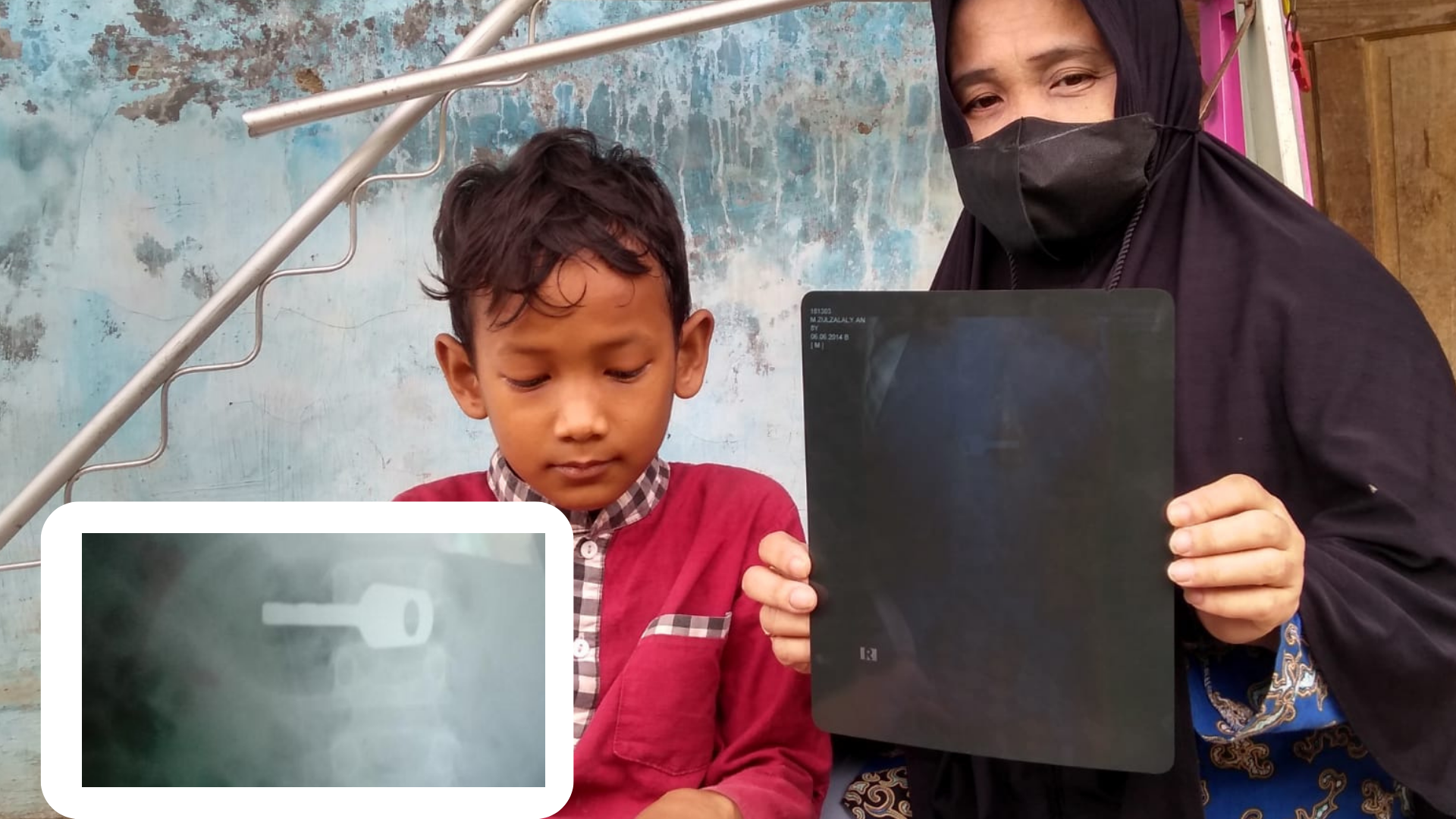 Ngeri! Anak di Indramayu Telan Kunci Gembok, Hasil Rontgen: Bersarang di Lambung