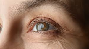 4 Hal yang Harus Dipersiapkan Sebelum Operasi Katarak  Ditinjau oleh: Dr. Kevin, SpM