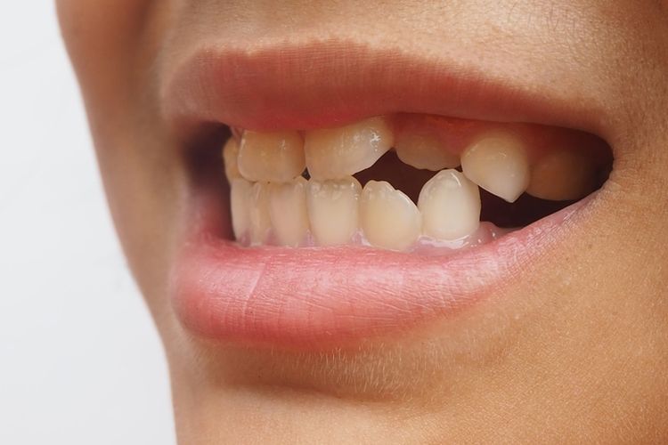 Gigi Anda Tidak Rapi, Ketahuilah 7 Penyebab dan 4 Cara Penanganannya