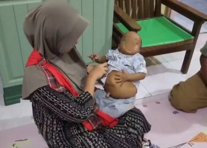 Mengenal Atresia Bilier, Penyakit Langka yang Mengancam Nyawa Bayi 8 Bulan di Cirebon