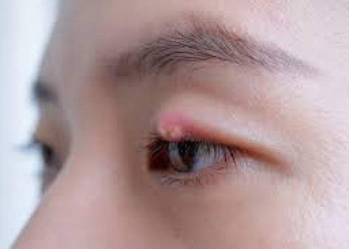 Mata Bintitan: Kapan Bisa Sembuh Sendiri dan Kapan Harus ke Dokter? 