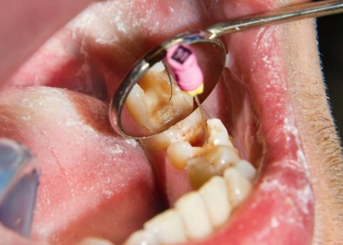 Cara Mengeluarkan Ulat Gigi dengan Kapas, Yuk! Simak Fakta Mengenai Ulat Gigi