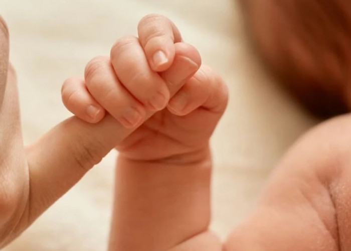 Bayi Kembar asal Ciawigajah alami Perut Dempet, Tidak Terdeteksi Sewaktu USG