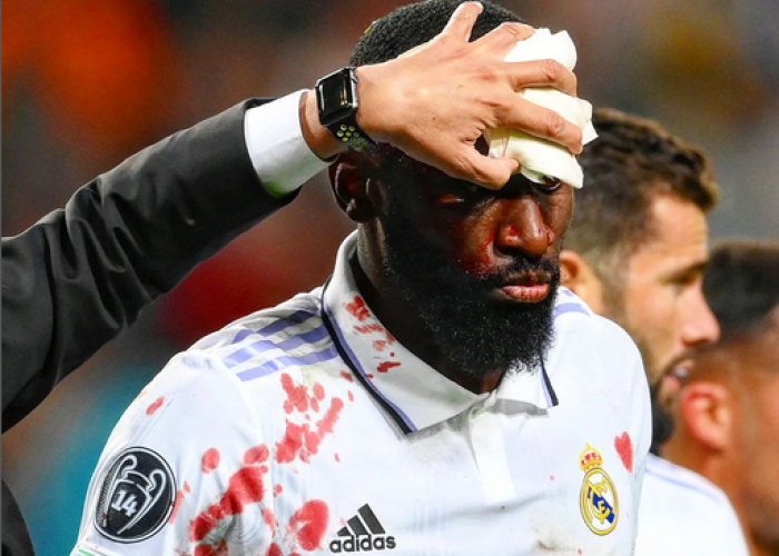 Kondisi Antonio Rudiger Setelah Jadi Pahlawan Real Madrid, Dapat 20 Jahitan