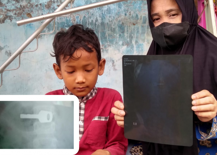 Ngeri! Anak di Indramayu Telan Kunci Gembok, Hasil Rontgen: Bersarang di Lambung
