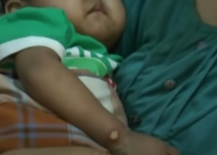 Penyakit Ginjal Bisa Menyerang Anak Kecil, Bahkan Sejak Dalam Kandungan