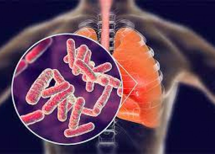 Cegah Penyebaran TBC di Dunia, WHO Keluarkan Informasi Cepat Tetang Ini… 